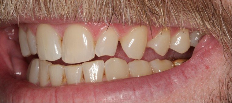 Smile before cosmetic treatment, case 1