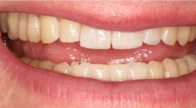 Smile after cosmetic treatment, case 2