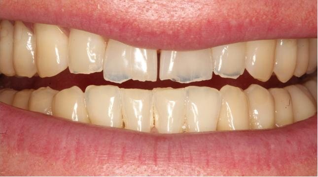 Smile before cosmetic treatment, case 2