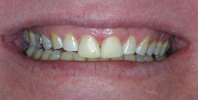 Smile after cosmetic treatment, case 3