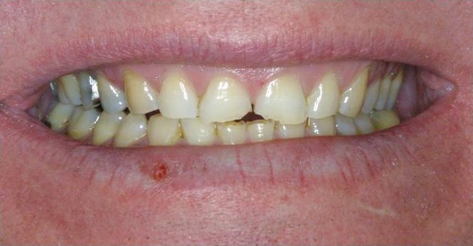 Smile before cosmetic treatment, case 3