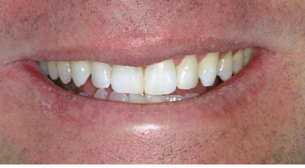 Smile after cosmetic treatment, case 4