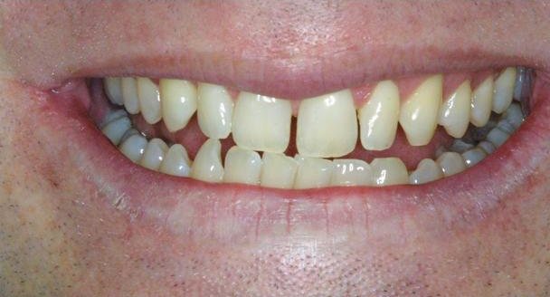 Smile before cosmetic treatment, case 4