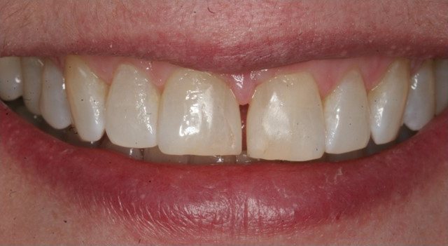 Smile after cosmetic treatment, case 5