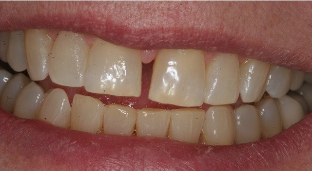Smile before cosmetic treatment, case 5