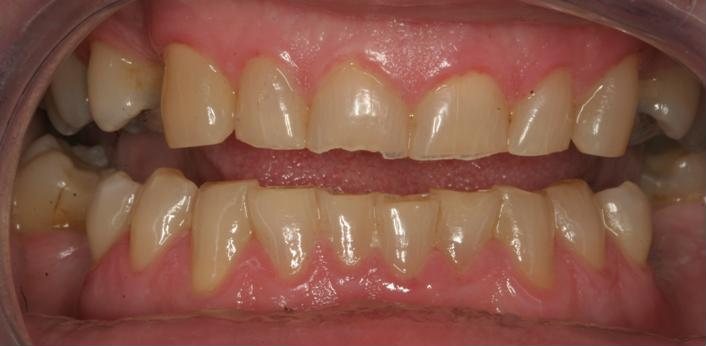 Smile before cosmetic treatment, case 6