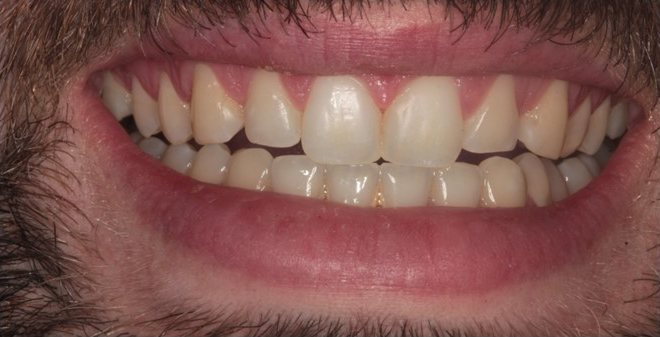 Smile after cosmetic treatment, case 7