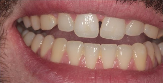 Smile before cosmetic treatment, case 7