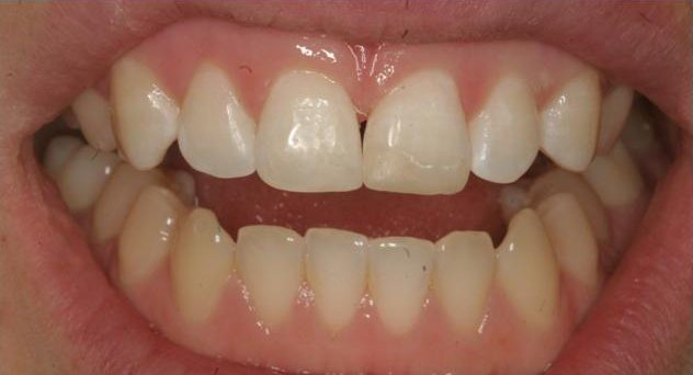 Smile after cosmetic treatment, case 8