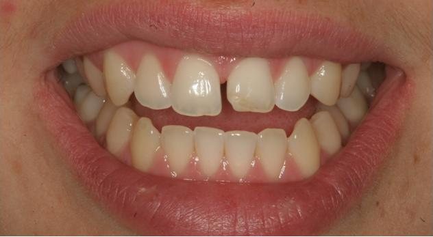 Smile before cosmetic treatment, case 8