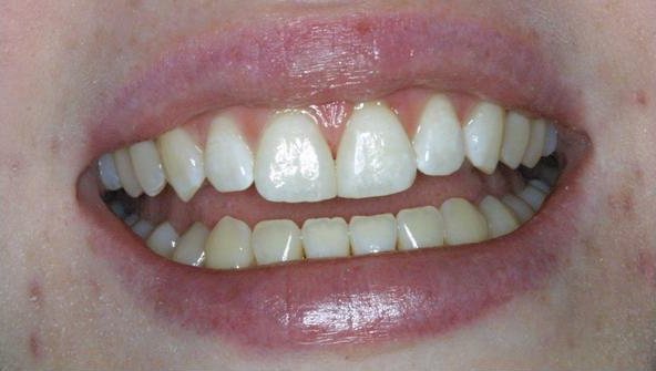 Smile after cosmetic treatment, case 9