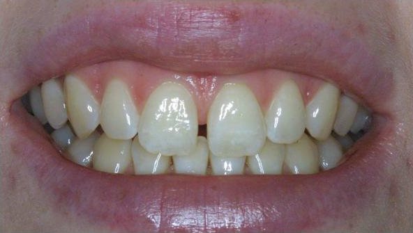 Smile before cosmetic treatment, case 9