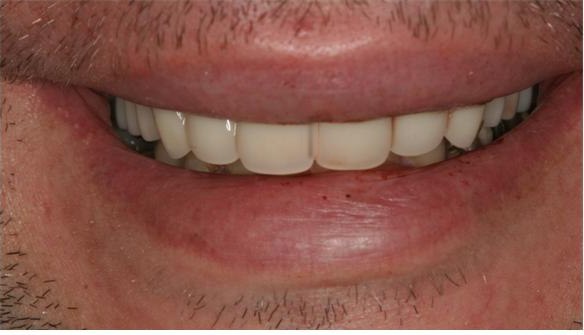 Patient's bright restored smile after treatment at Aviation Dental