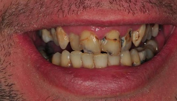 Patient's damaged, stained teeth before treatment at Aviation Dental